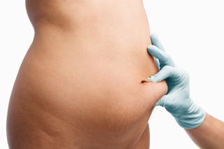 body liposuction fat tummy flat stomach apesos