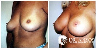breast_augmentation
