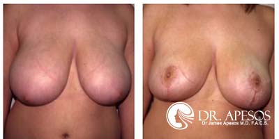 breast_reduction11