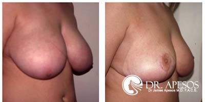 breast_reduction21