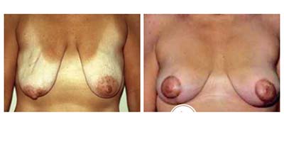 mastopexy_6