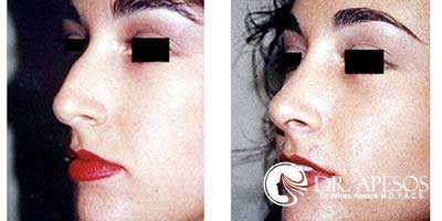 nosejob2