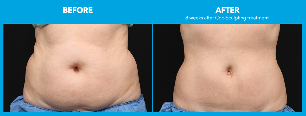 coolsculpting-before-after-pictures-coolsculpting