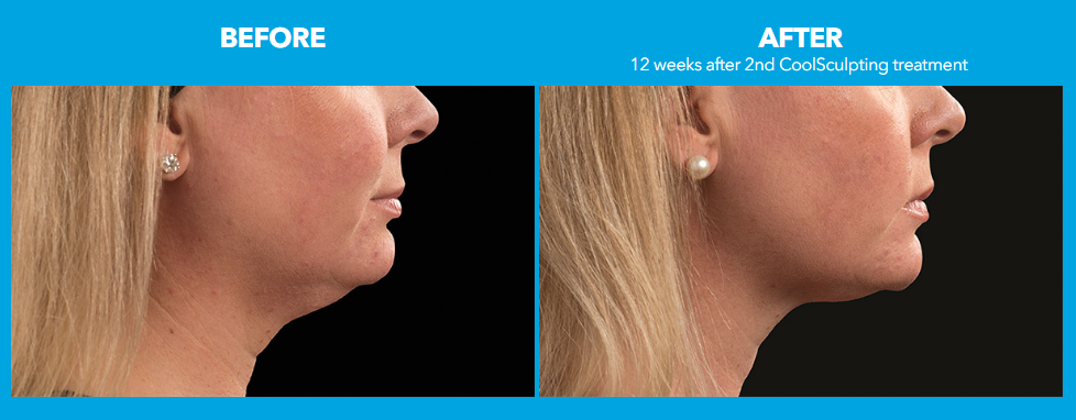 coolsculpting-before-after-pictures2-coolsculpting