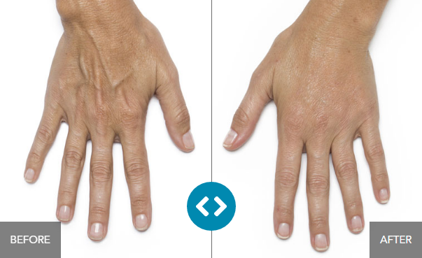 dermal-fillers-for-hands-before-and-after-from-radiesse-radiesse