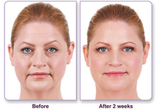 JUVÉDERM® Ultra XC and JUVÉDERM® XC
