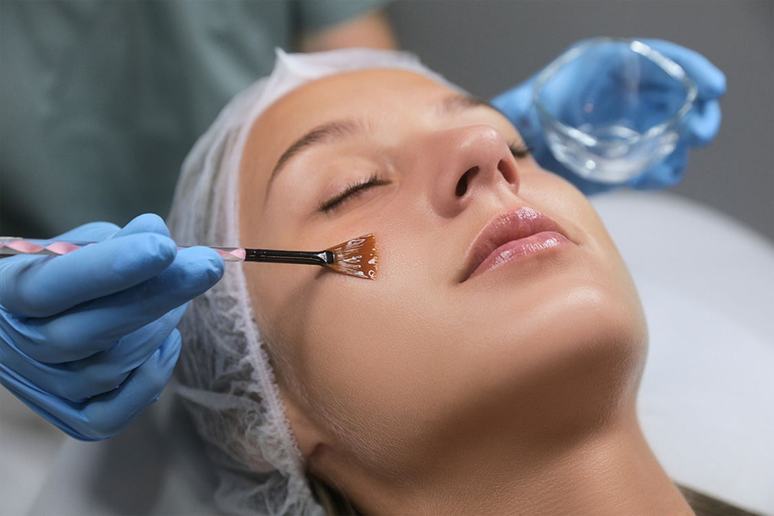 woman lying down having chemical facial peel applied; finding the right facial peel for you