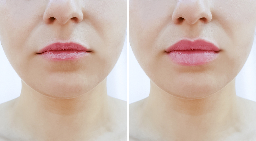 girl lips before and after lip procedure