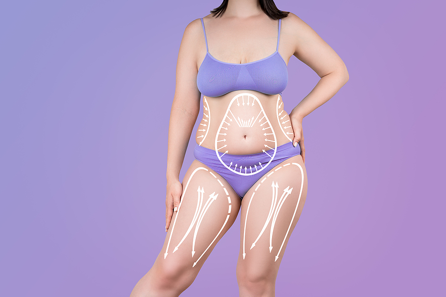 Full body cosmetic surgery; liposuction, legs, hips, abdomen and breast augmentation, fat and cellulite removal concept, overweight female body with painted surgical lines and arrows on violet background