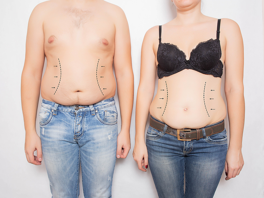 Man and woman overweight on a white background. Abdominoplasty and liposuction plastic surgery concept, markers on the abdomen