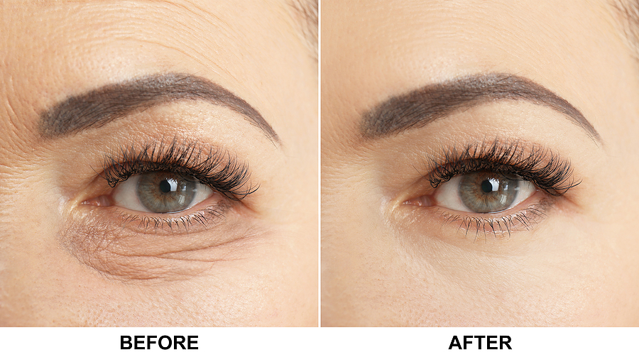 Mature woman before and after blepharoplasty procedure, closeup. Eye Lift Surgery