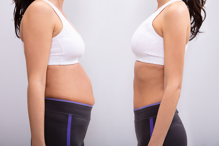 Side View Of Before And After Concept Showing Fat To Slim Woman; signs you might consider a tummy tuck or abdominoplasty