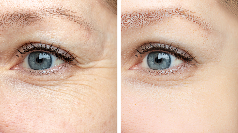 Woman's face, eye wrinkles before and after treatment - the result of rejuvenating cosmetological procedures of biorevitalization, face lifting and pigment spots removal. Keeping your eyes looking younger