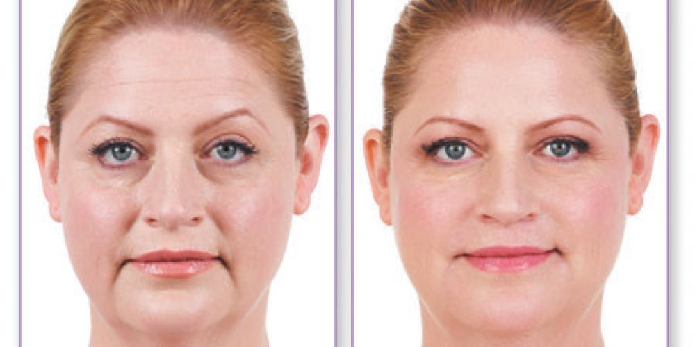 Juvederm May Help Correct Your Nasolabial Folds Without Surgery