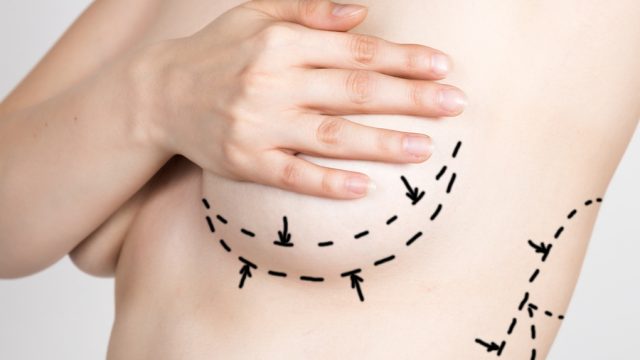 Breast Augmentation: Preparing for a Successful Recovery