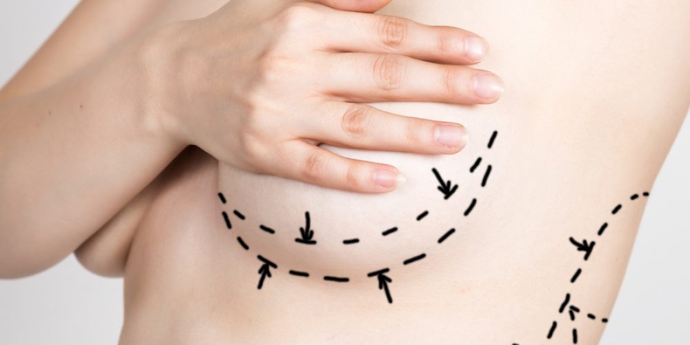 Choosing the Right Surgeon for Breast Augmentation Surgery