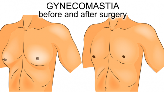What is Gynecomastia and How Do You Treat It?