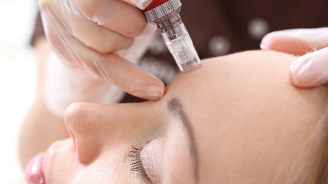 Four Things You Need to Know About Microneedling Treatment