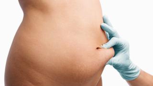 Liposuction Procedures Very Popular