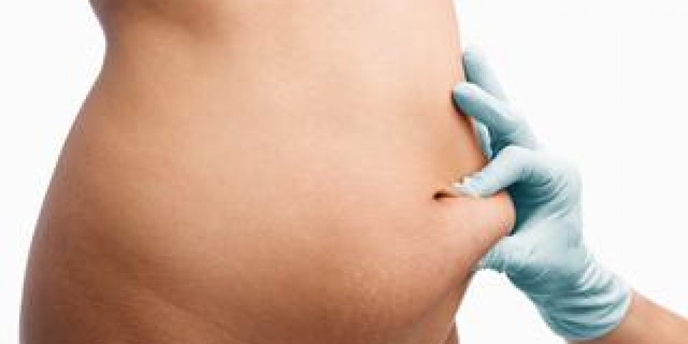 Liposuction Procedures Very Popular