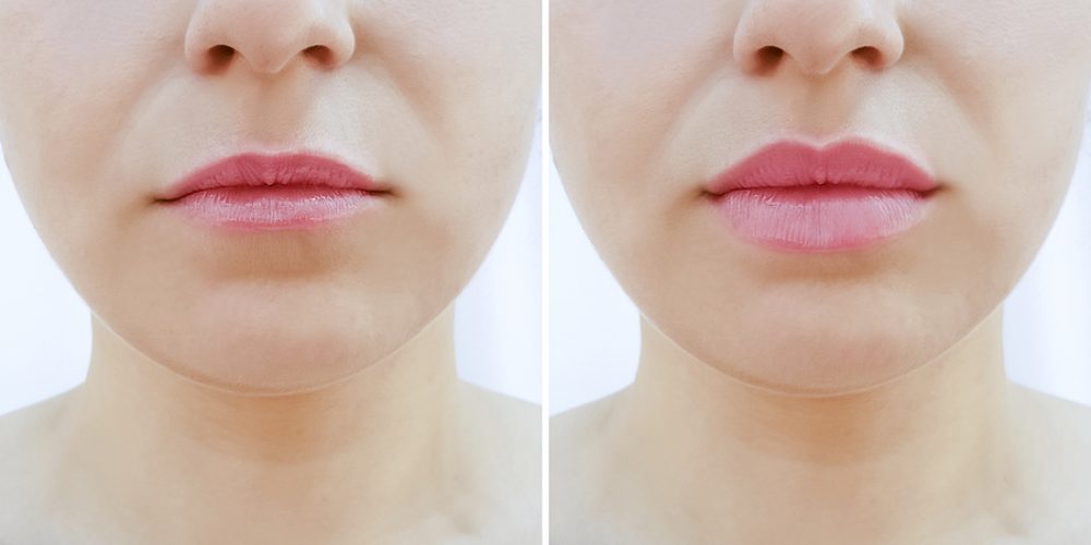 How to Get Fuller Lips: Temporary Vs. Permanent Lip Procedure Solutions