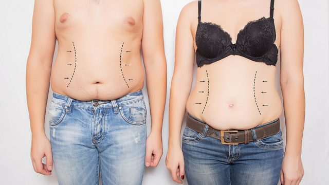 Tummy Tuck 101: Your Comprehensive Guide to Abdominoplasty