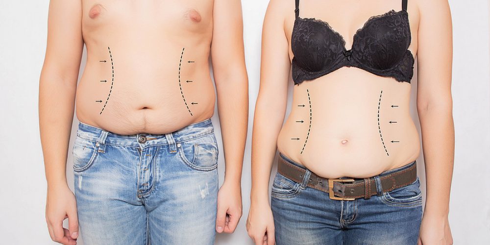 Tummy Tuck 101: Your Comprehensive Guide to Abdominoplasty