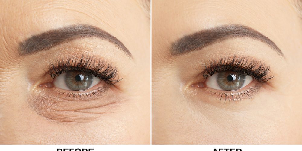 The Benefits of Eye Lift Surgery: A Comprehensive Guide