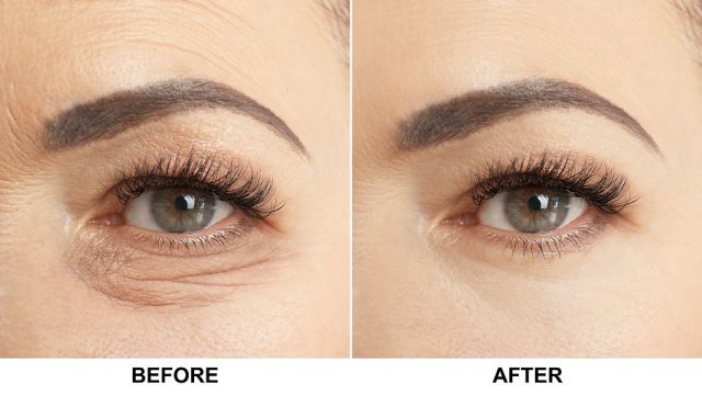 The Benefits of Eye Lift Surgery: A Comprehensive Guide