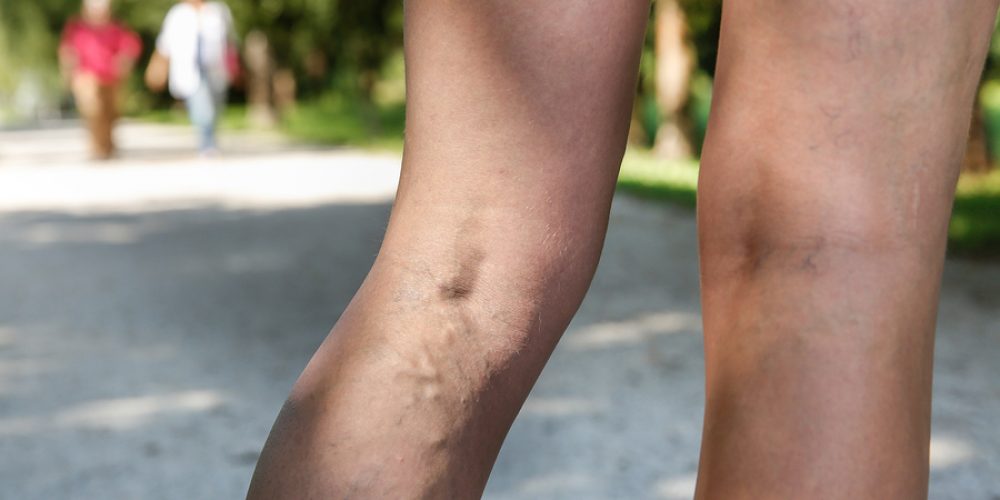 Does Sclerotherapy Impede Blood Flow?
