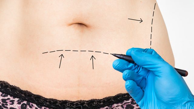 Is CoolSculpting Better Than Liposuction?