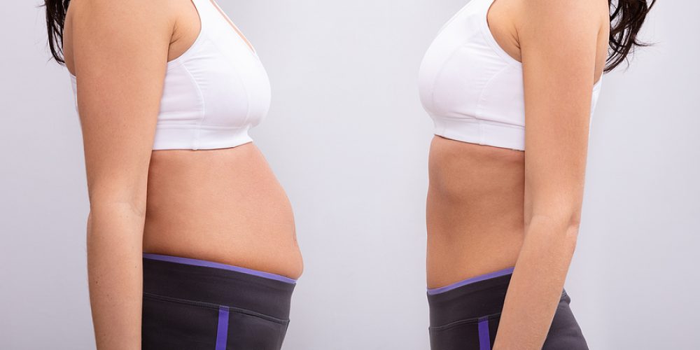 Signs It’s Time to Consider a Tummy Tuck for a Stronger, More Toned Core