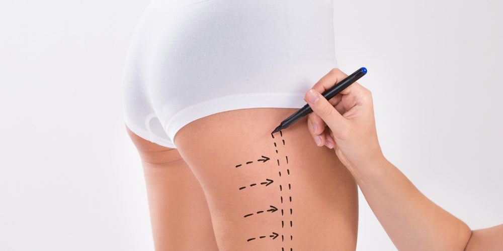 Discover the Amazing Benefits of Liposuction
