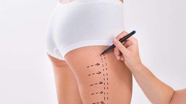 Discover the Amazing Benefits of Liposuction