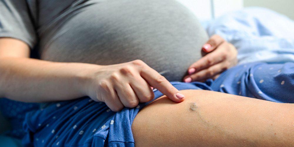 5 Ways to Prevent Varicose Veins During Pregnancy