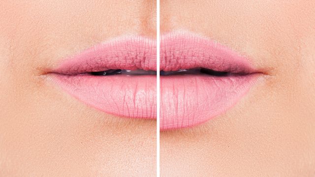 Can You Actually Look Happier With Lip Augmentation?