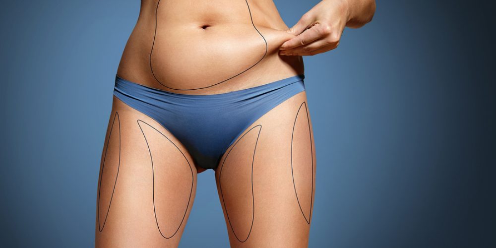 How Does CoolSculpting Compare with Liposuction?