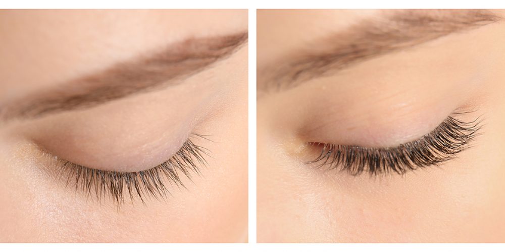 Is Latisse™ Eyelash Treatment Right For You?