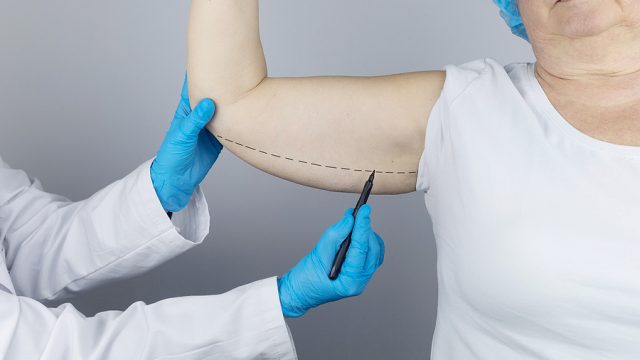 What is it Like to Get an Arm Tuck?