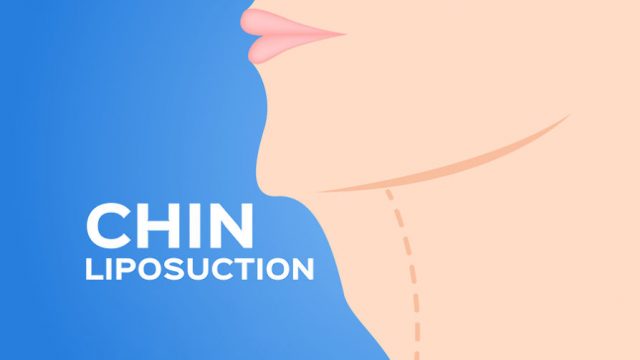 Plastic Surgery Success Story: Chin Liposuction