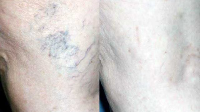 Varicose Veins and Sclerotherapy