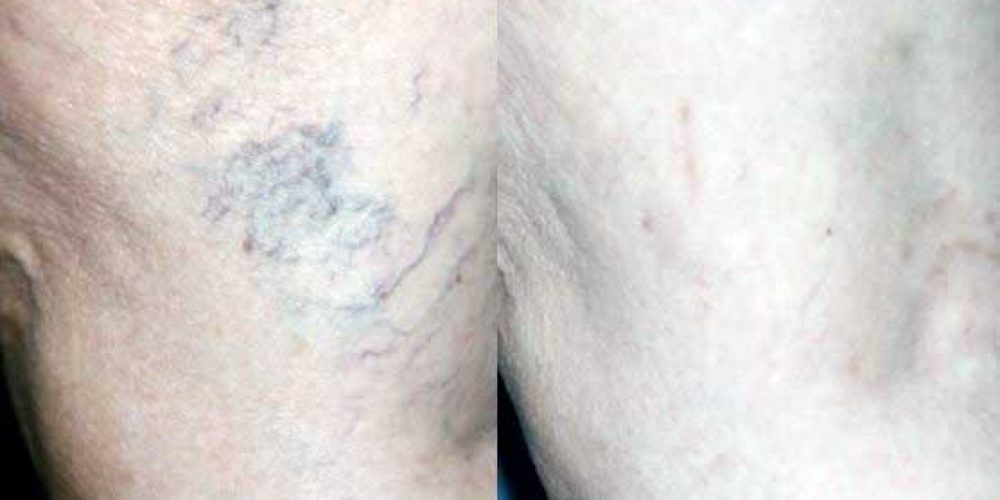 Sclerotherapy for the removal of spider and varicose veins
